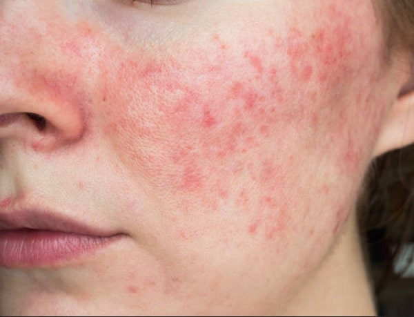La dermatitis tratamiento con Homeopatía